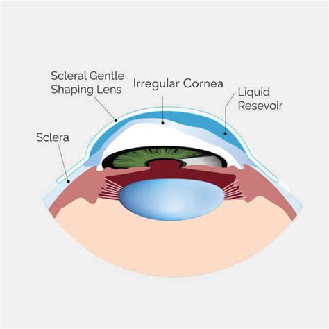  Scleral lens. Side view displaying vaulted area of a scleral lens. A scleral lens, also known as a scleral contact lens, is a large contact lens that rests on the sclera and creates a tear -filled vault over the cornea. Scleral lenses are designed to treat a variety of eye conditions, many of which do not respond to other forms of treatment. 